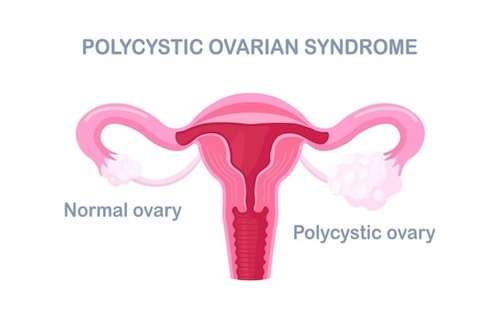Tips for PCOS Sufferers 