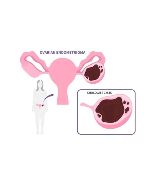 চকলেট সিস্ট ও পলিসিস্টিক ওভারি: কারণ ও সমাধান 