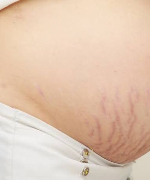 stretch mark Tips to Avoid Stretch Marks in Pregnancy